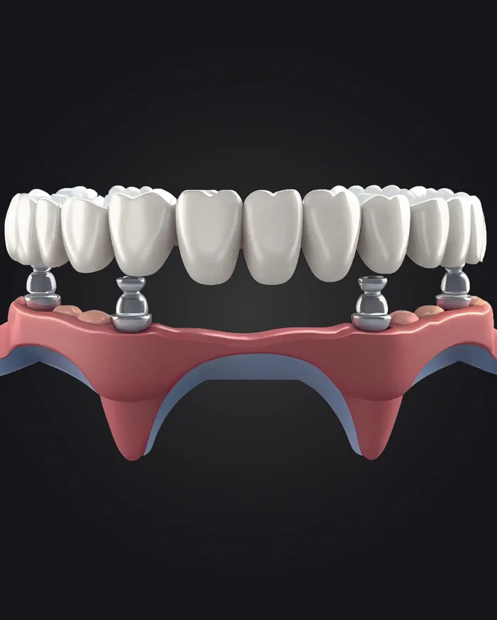 Dental Veneers Antalya